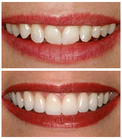 Dental veneers - before and after