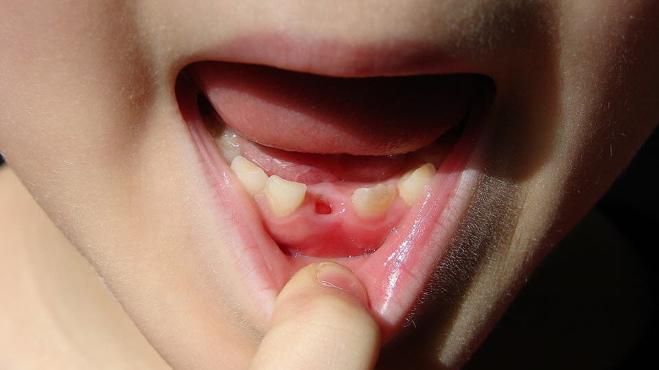 Child with missing front tooth