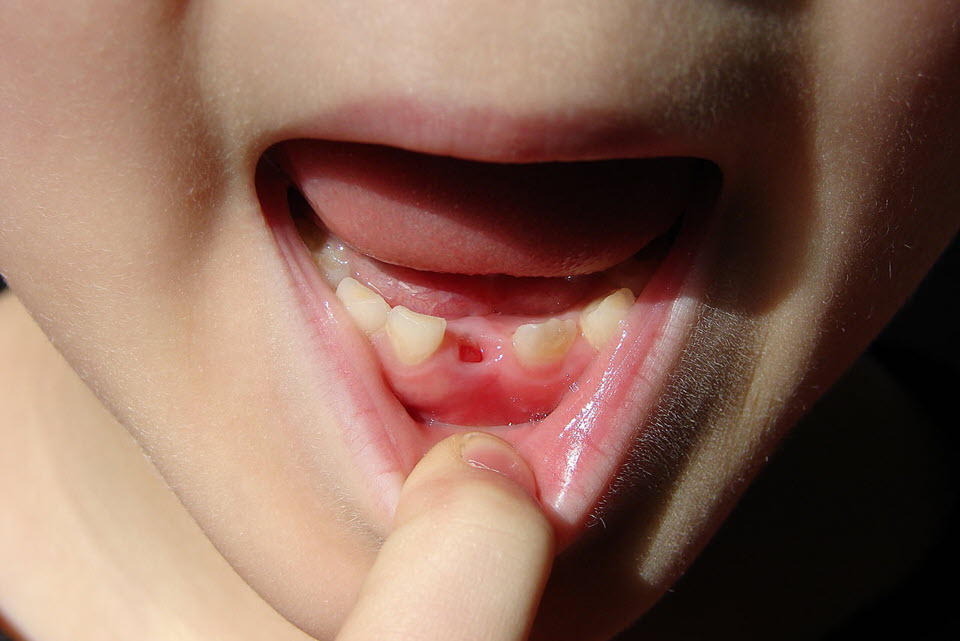 Child with missing front tooth