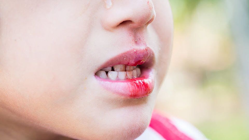 Dental Emergency – little boy bleeding at the mouth
