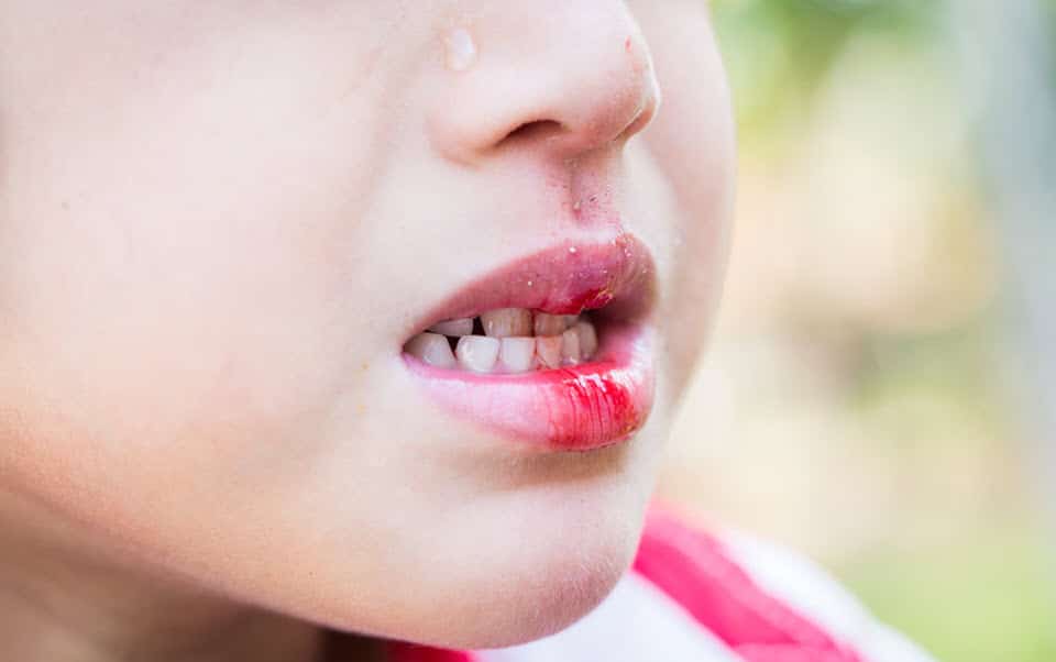 Dental Emergency – little boy bleeding at the mouth